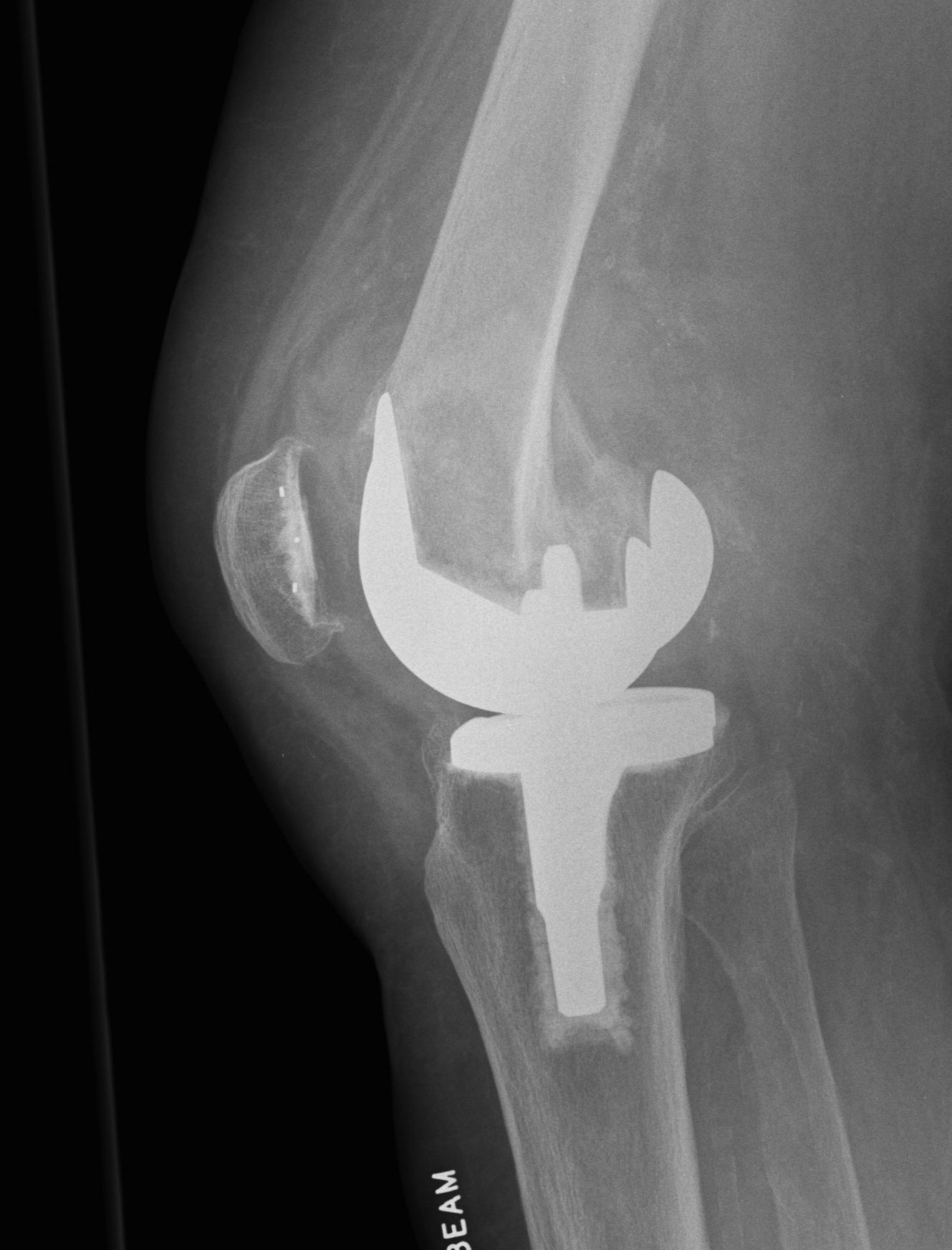 TKR Periprosthetic Fracture Lateral